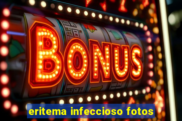 eritema infeccioso fotos